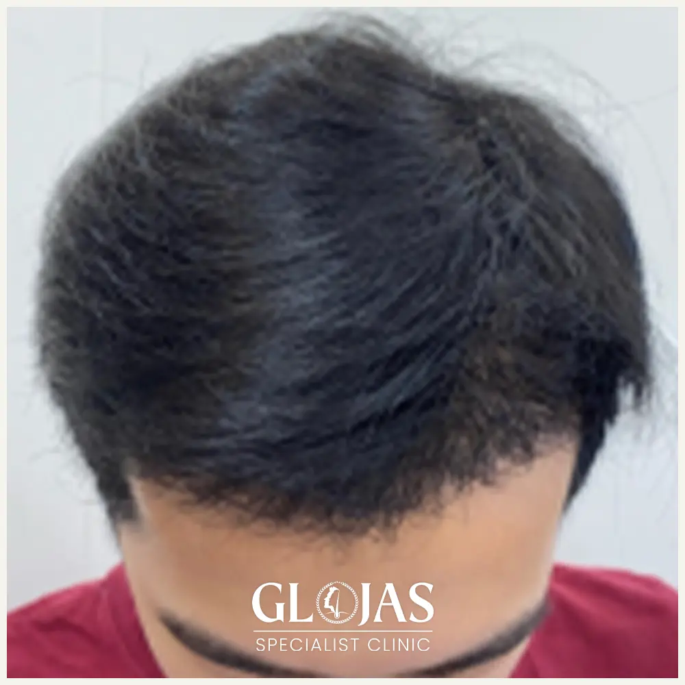 hair transplant malaysia specialist before after 9 1