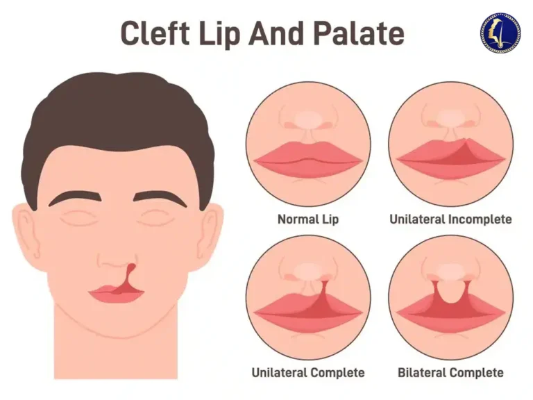 moustache-transplant-malaysia-cleft-palate