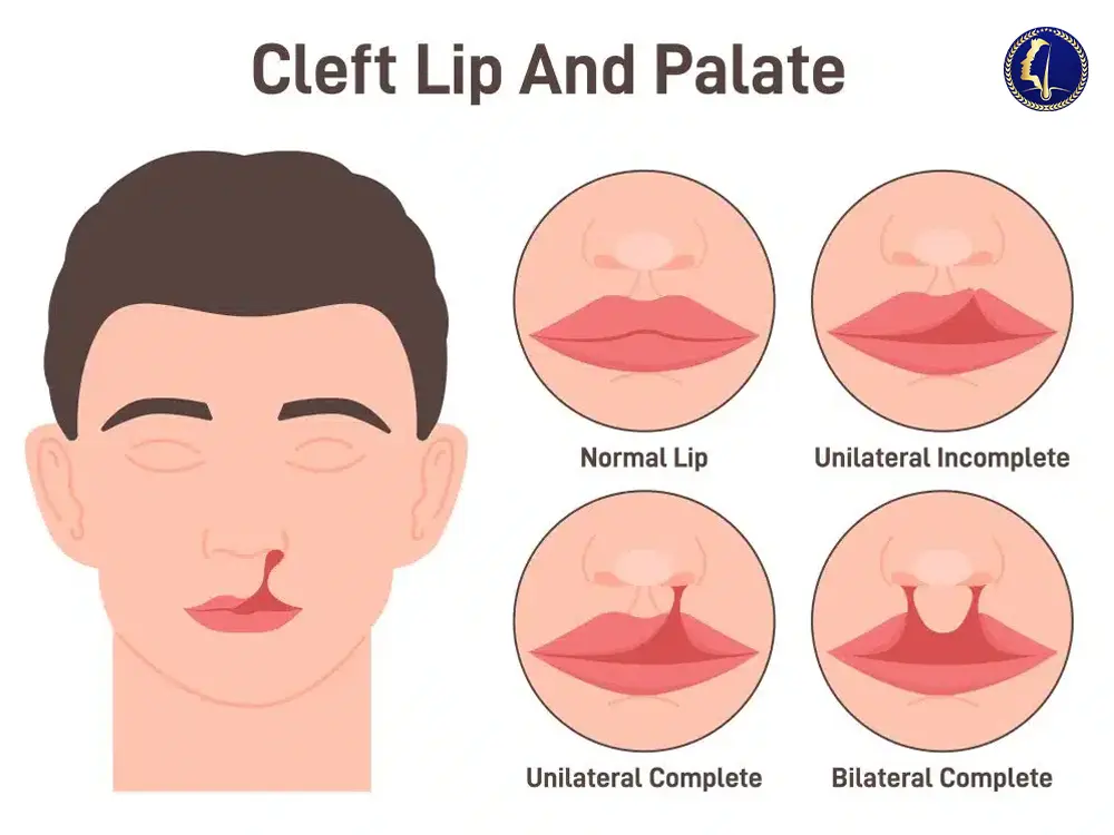 Glojas Clinic’s Moustache Transplant: A Life-Changing Solution for Men with Cleft Palate