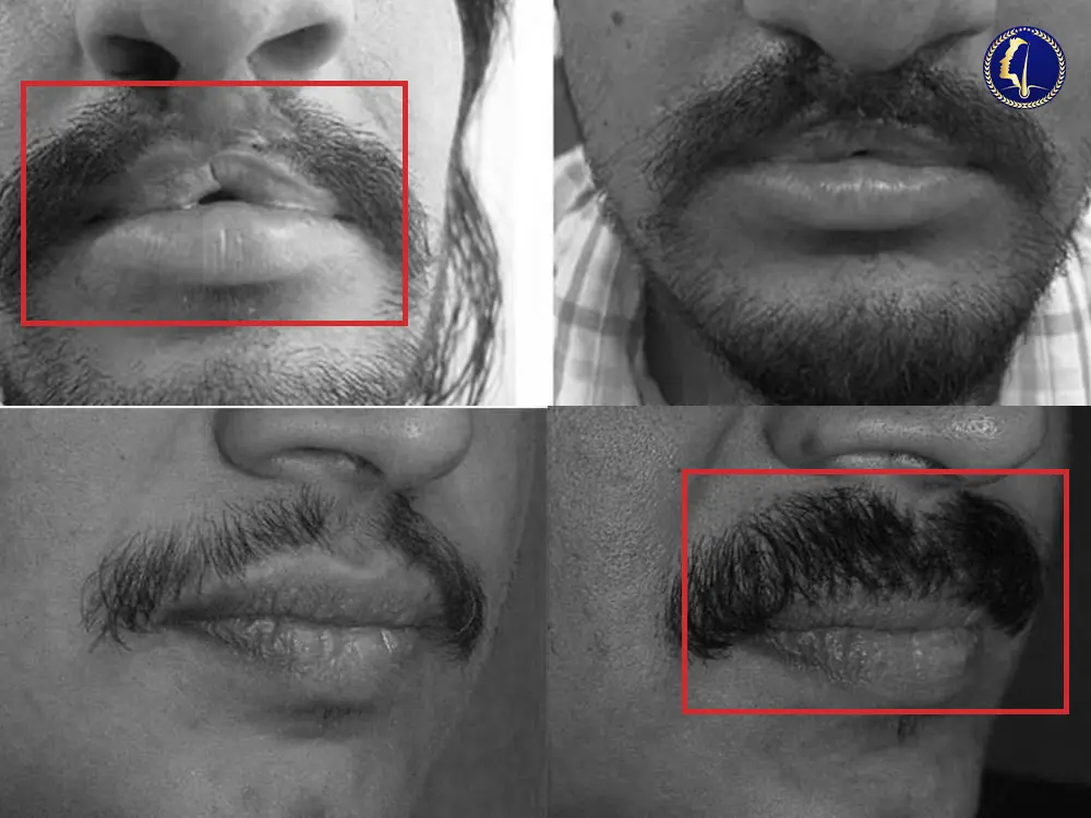 moustache-transplant-malaysia-cleft-palate-2 