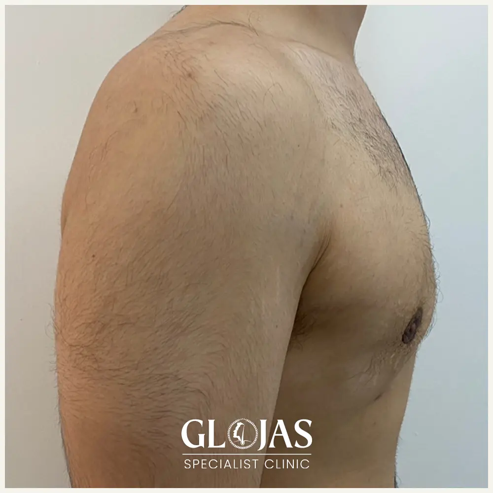 plastic surgery malaysia before afte gynecomastia 1