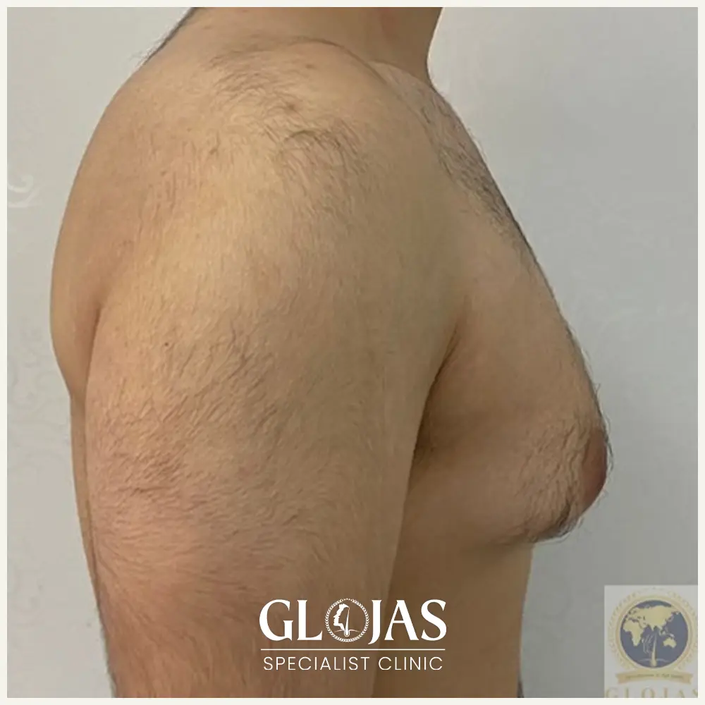 plastic surgery malaysia before afte gynecomastia