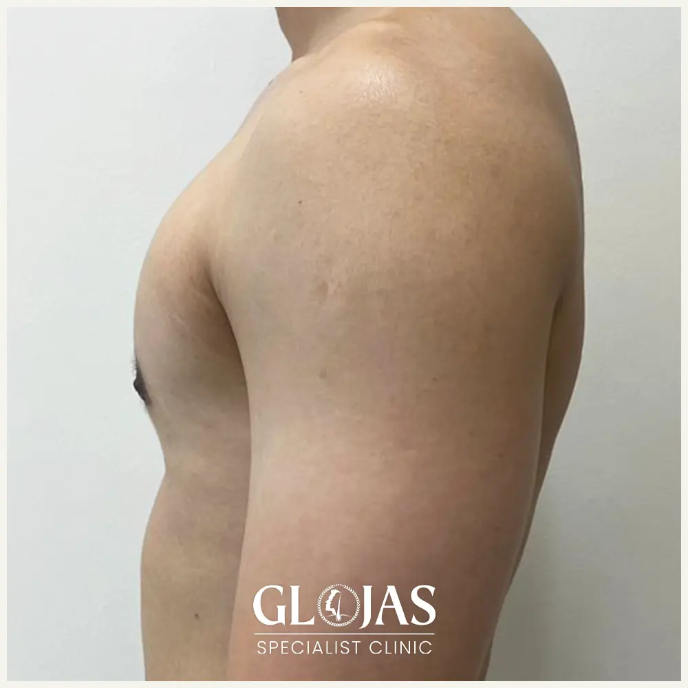 plastic surgery malaysia before after Gynecomastia 1 2