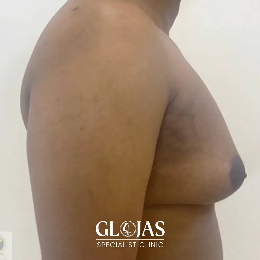 plastic surgery malaysia before after Gynecomastia 1