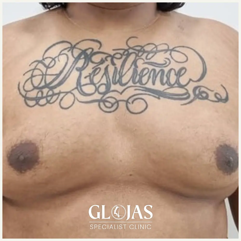 plastic surgery malaysia before after Gynecomastia 3 1