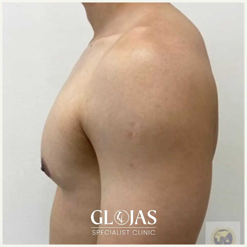 plastic surgery malaysia before after Gynecomastia 3