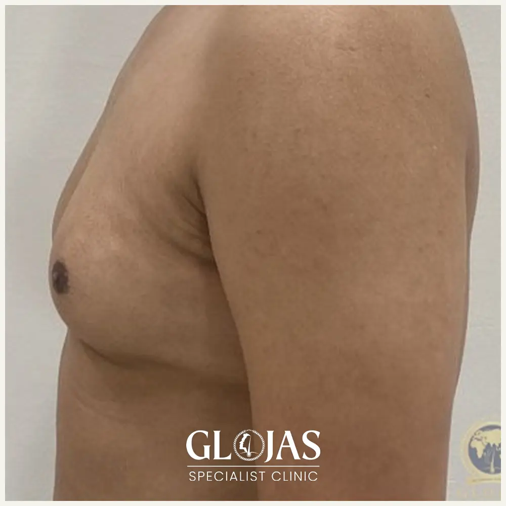 plastic surgery malaysia before after Gynecomastia 5