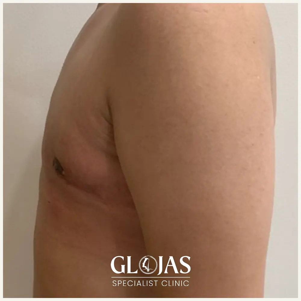 plastic surgery malaysia before after Gynecomastia 6