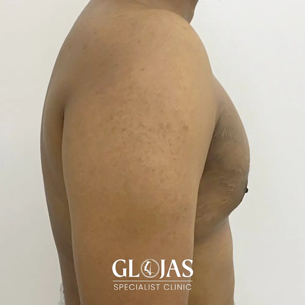 plastic surgery malaysia before after Gynecomastia