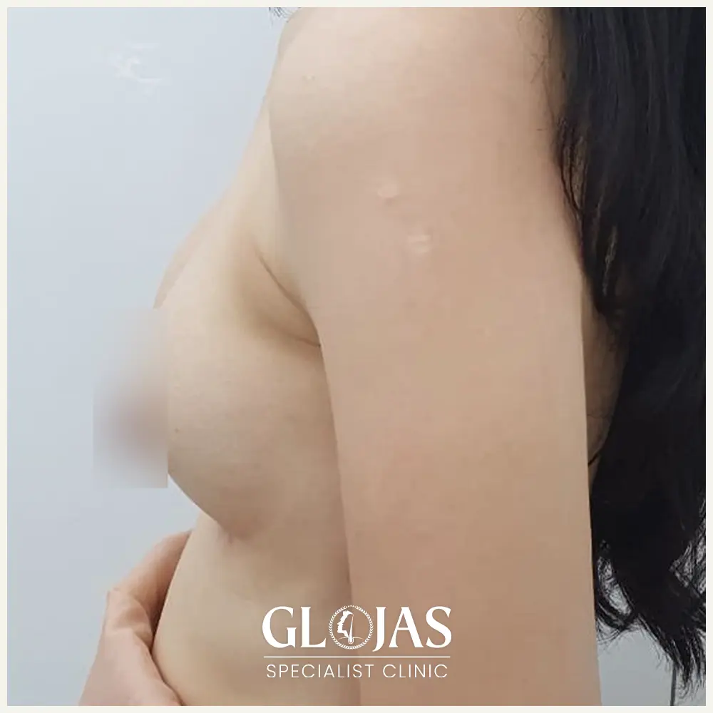 plastic surgery malaysia before after breast implant 1