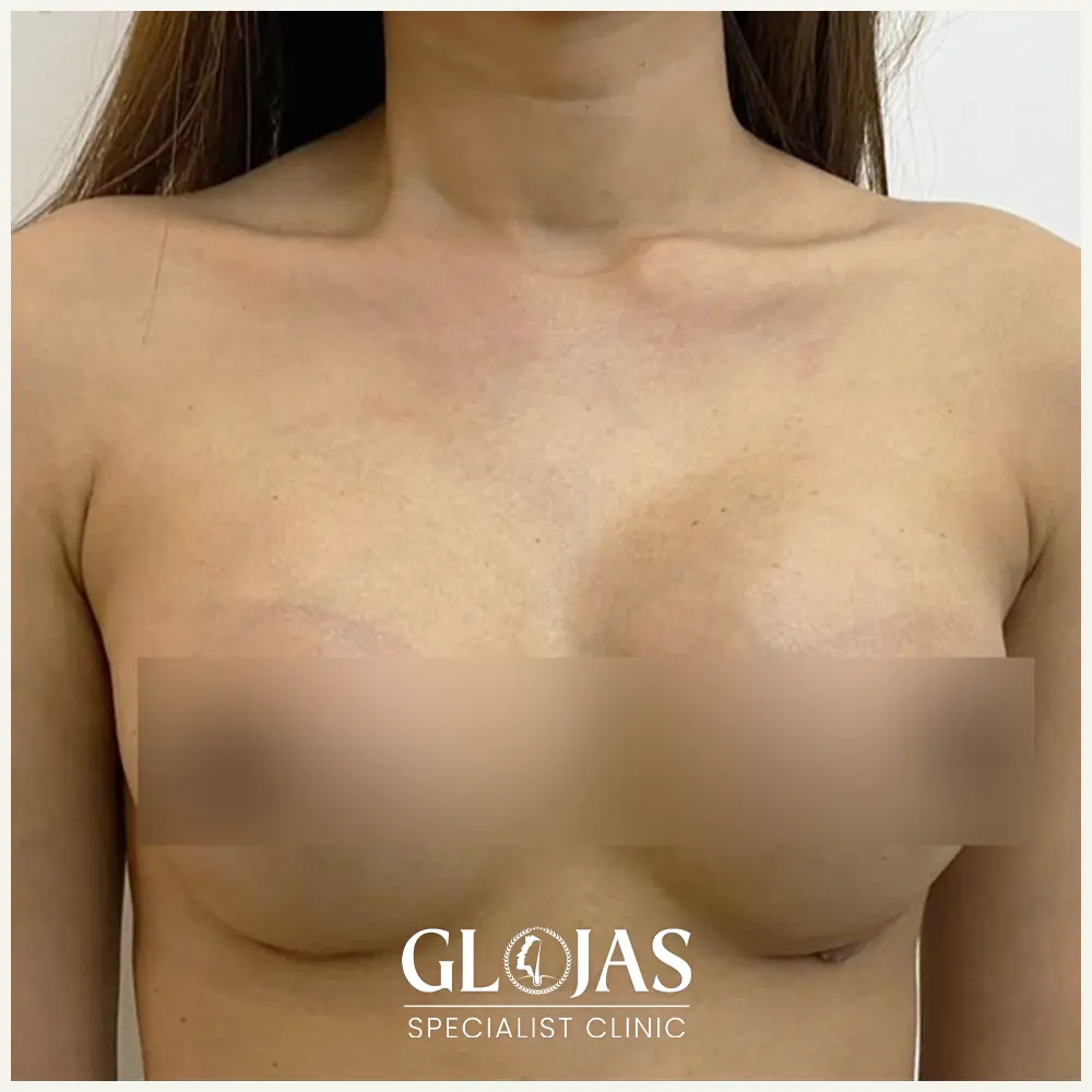 plastic surgery malaysia before after breast implant 3