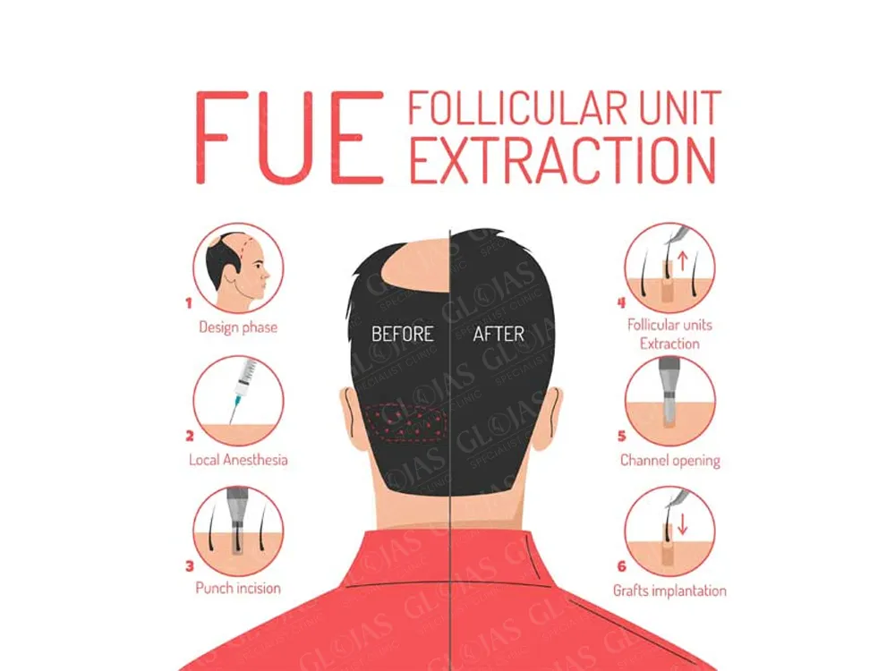 How-long-does-a-FUE hair-transplant-last