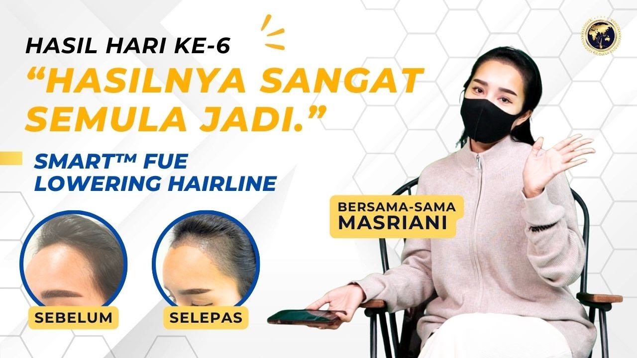Tanam Rambut Malaysia | Hasil Terbaik & Kos Tanam Rambut Malaysia | Tanam Rambut Hari Ke-6