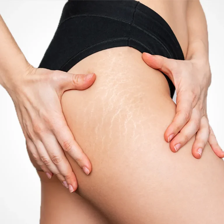 aesthetic-clinic-malaysia-kl-stretch-mark-cellulite