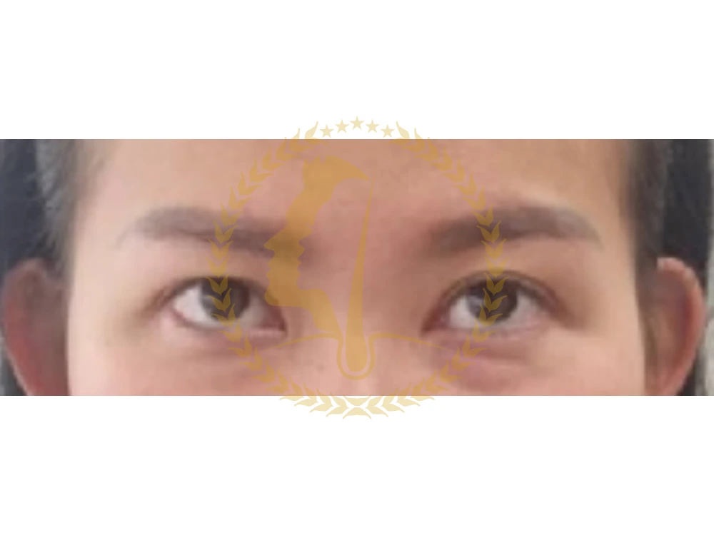 cara-eyebag,cara-eyebag-glojas,cara-eyebag-klinik,cara-eyebag-malaysia