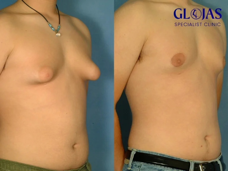 cara-hilangkan-gynecomastia,cara-hilangkan-gynecomastia-glojas,cara-hilangkan-gynecomastia-malaysia,cara-hilangkan-gynecomastia-klinik