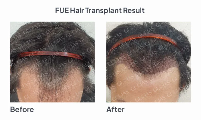 fue-hair-transplant-result-malaysia-kuala-lumpur