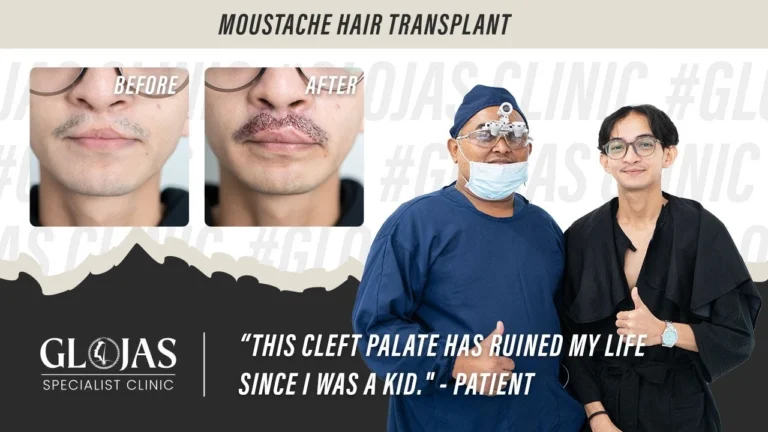 hair-transplant-malaysia