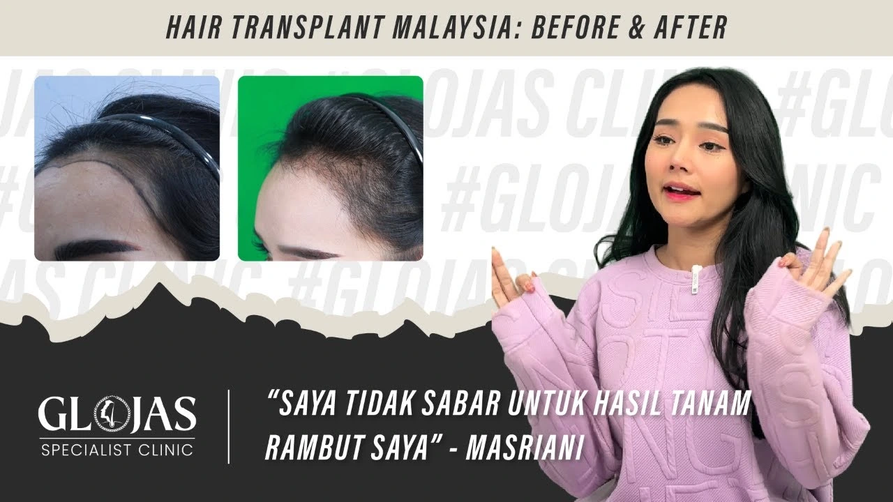 Hair Transplant in Malaysia | Best Results & Cost of Hair Transplant in Malaysia