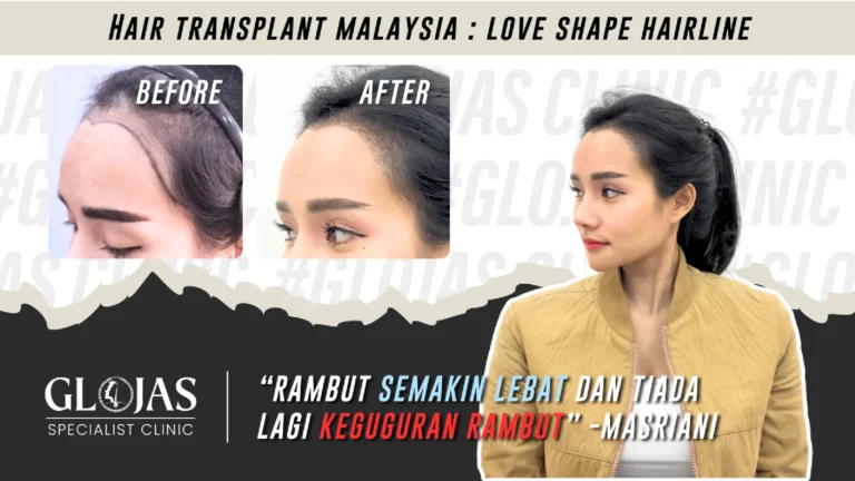 hair-transplant-malaysia-centre-cost-before-after