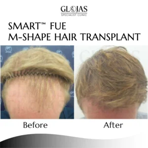 hair-transplant-malaysia-centre-before-after-results