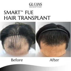 hair-transplant-malaysia-centre-before-after-results