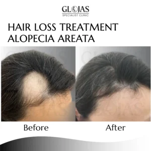 hair-transplant-malaysia-centre-before-after-results