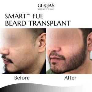 hair-transplant-malaysia-clinic-kuala-lumpur-beard