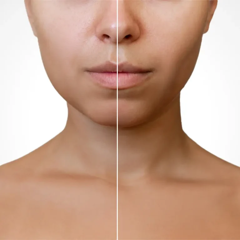 Buccal Fat Removal Surgery for Natural-Looking Slimmer, Sculpted Cheeks