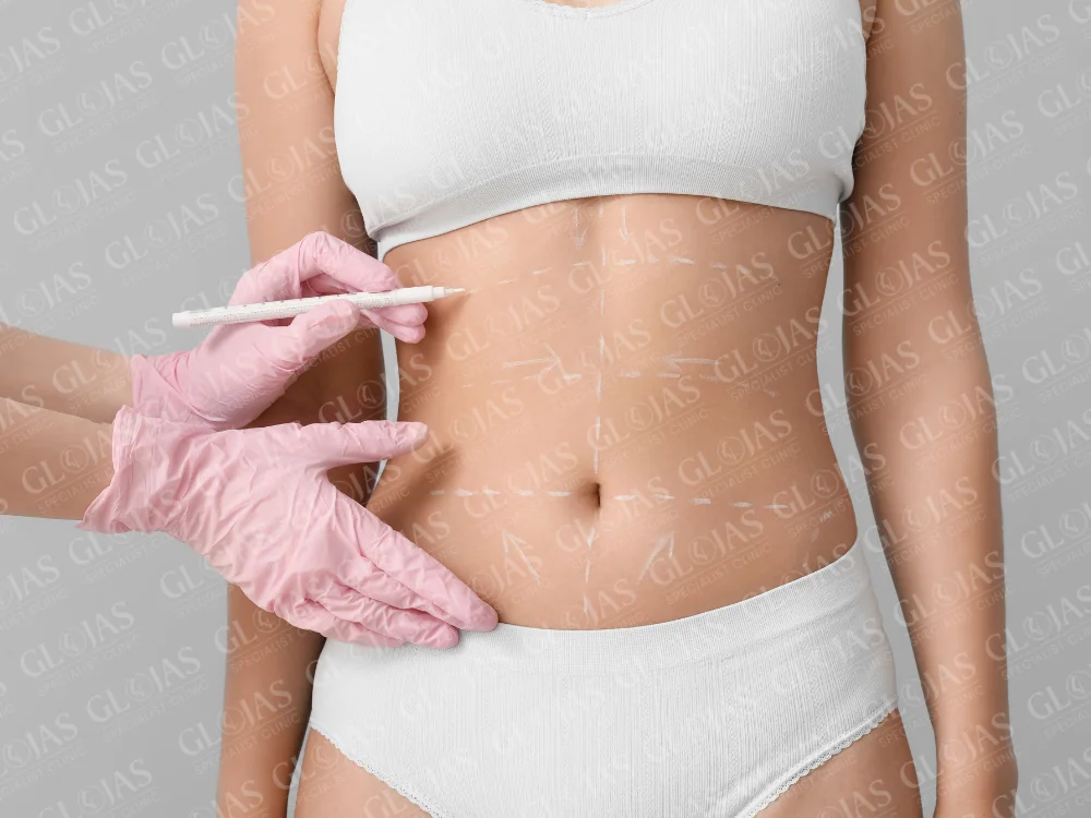 abdominoplasty