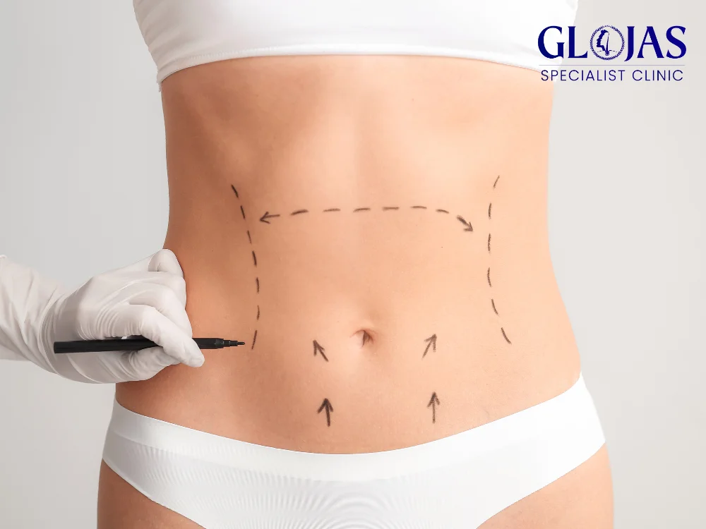 abdominoplasty