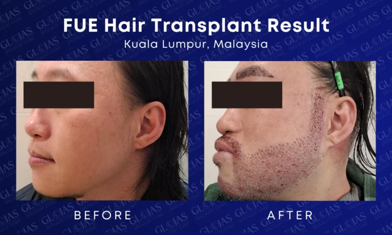 fue-hair-transplant-malaysia-medical-expert-center-hairloss-before-after-kuala-lumpur-beard-transplant