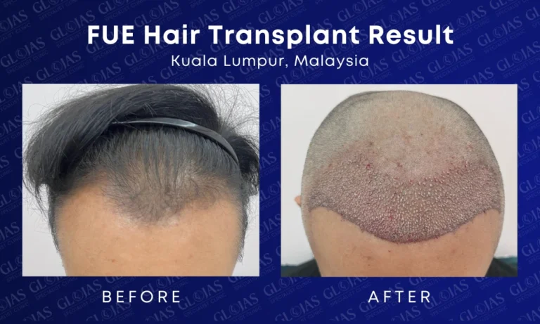 fue-hair-transplant-malaysia-medical-expert-center-hairloss-before-after-kuala-lumpur-2