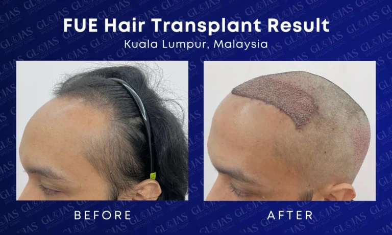 fue hair transplant malaysia medical expert center hairloss before after kuala lumpur 3