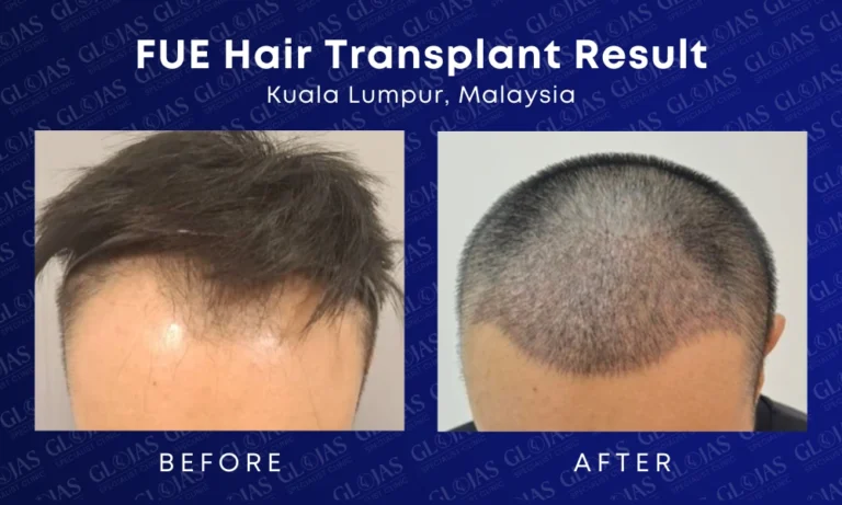 fue hair transplant malaysia medical expert center hairloss before after kuala lumpur 4