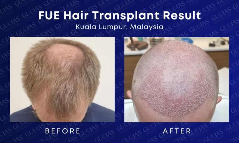 fue-hair-transplant-malaysia-medical-expert-center-hairloss-before-after-kuala-lumpur-5