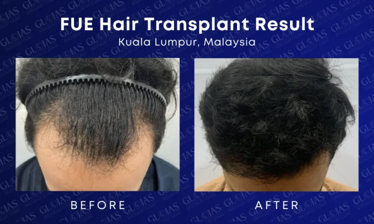 fue hair transplant malaysia medical expert center hairloss before after kuala lumpur 6