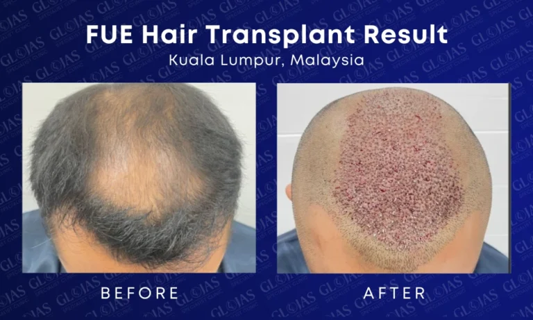 fue hair transplant malaysia medical expert center hairloss before after kuala lumpur 7