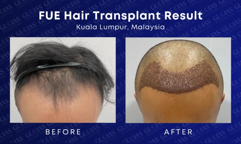 fue-hair-transplant-malaysia-medical-expert-center-hairloss-before-after-kuala-lumpur