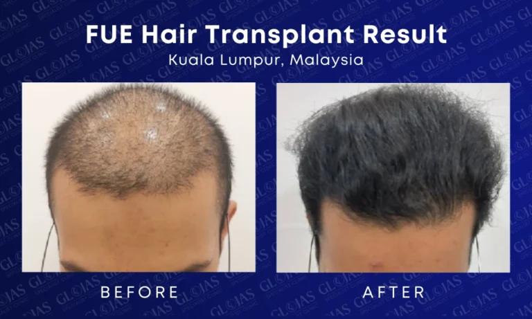 fue-hair-transplant-malaysia-medical-expert-center-hairloss-before-after-kuala-lumpur-8