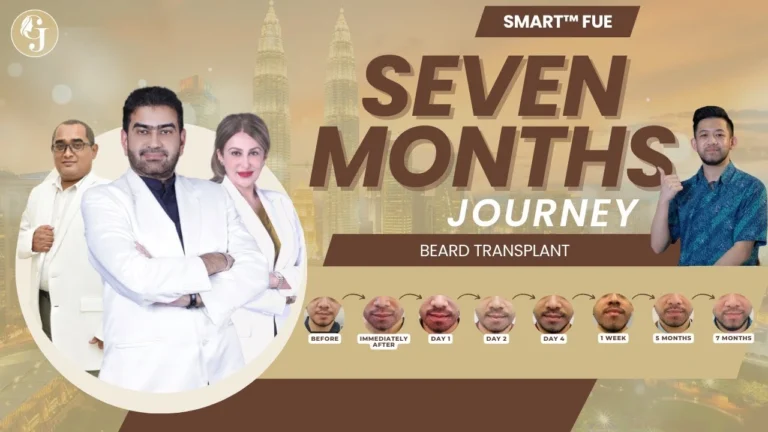 7-Month-Review-After-SMART™-FUE-Hair-Transplant-Malaysia