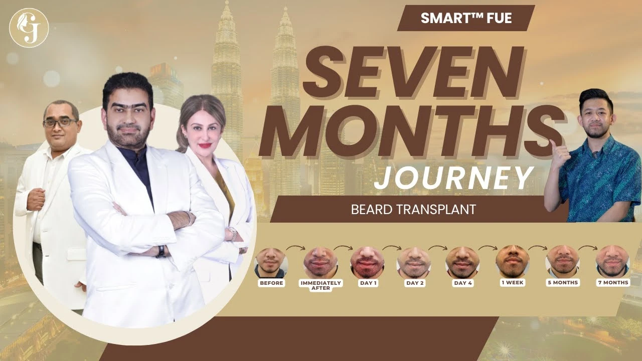 7-Month Review After SMART™ FUE Hair Transplant Malaysia