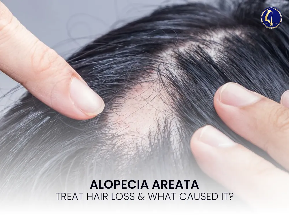 alopecia-areata-cause-treatments-2025