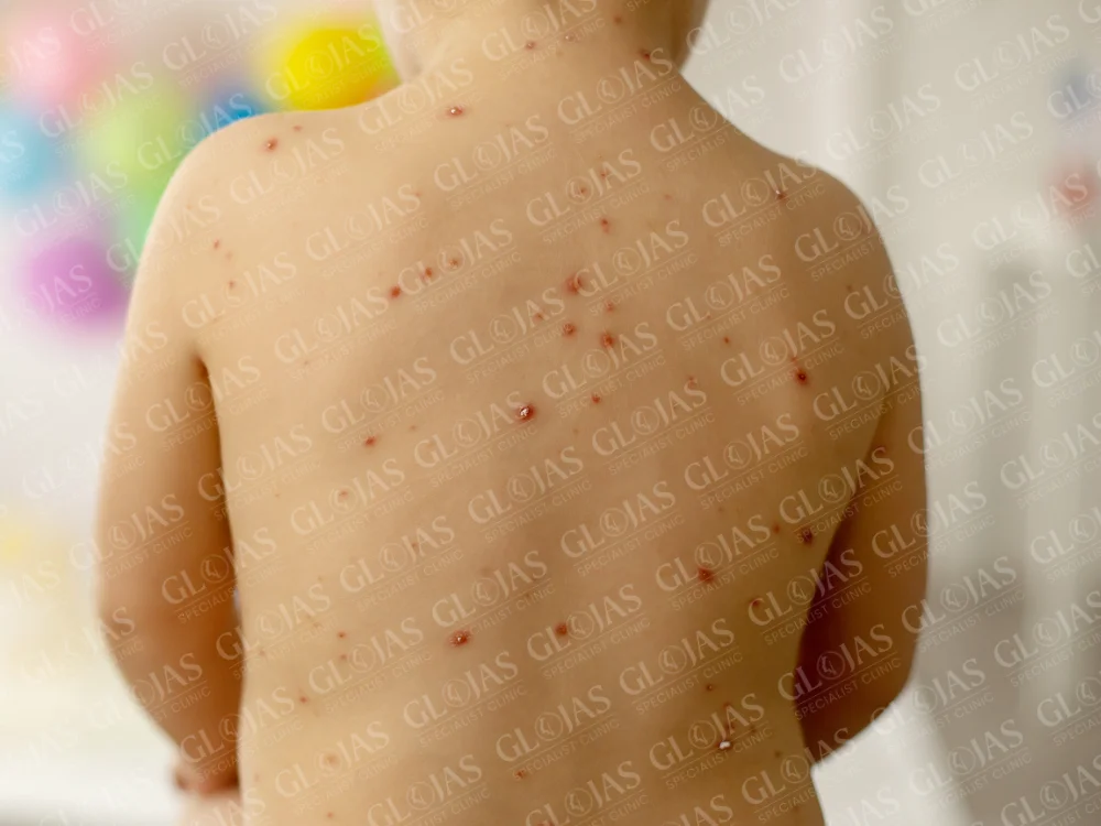 chicken-pox-scars