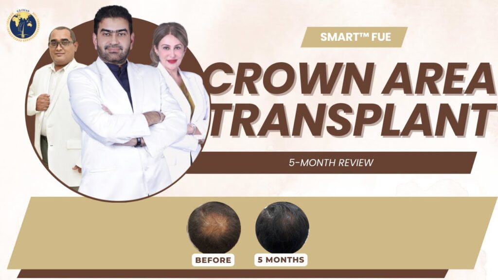 crown-area-hair-transplant-in-malaysia