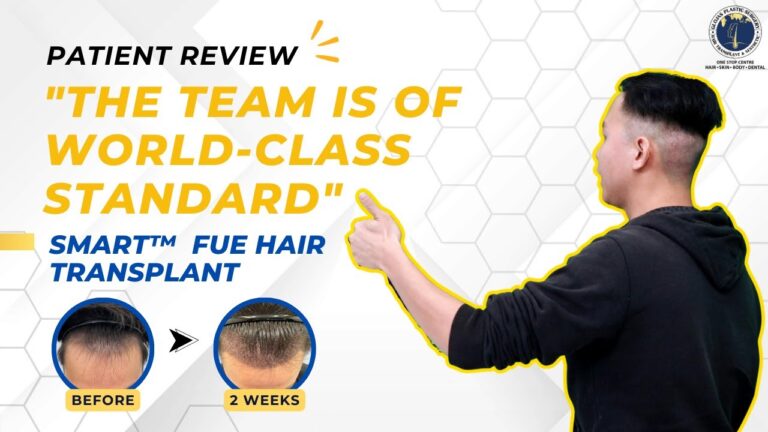 fue-hair-transplant-transformation-in-malaysia