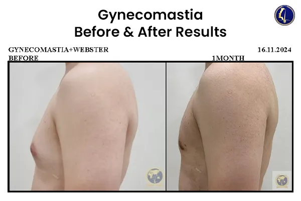 gynecomastia-fat-removal-man-boobs-plastic-surgery-malaysia-1