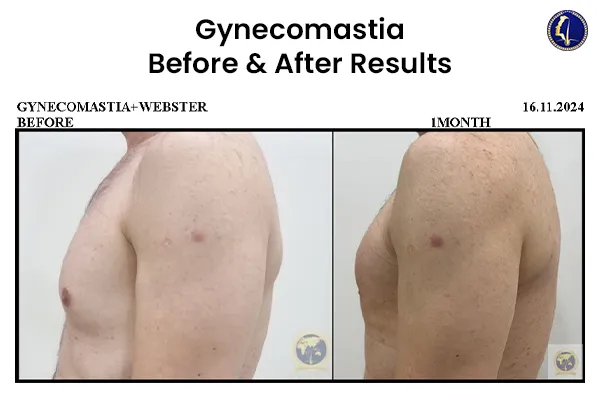 gynecomastia-fat-removal-man-boobs-plastic-surgery-malaysia