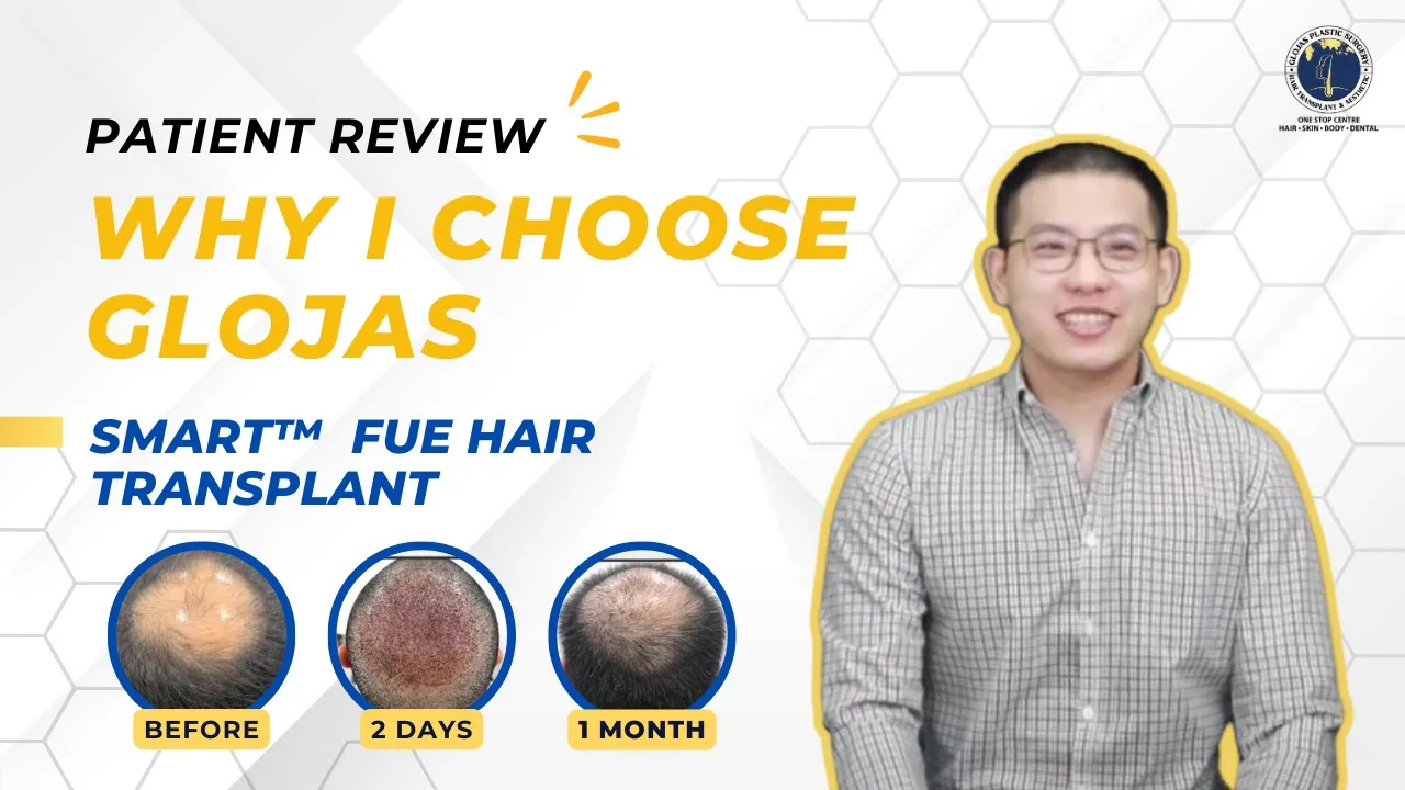 Hair Transplant in Malaysia | Best Results & Cost of Hair Transplant in Malaysia | My Honest Review at Glojas Hair Transplant Clinic