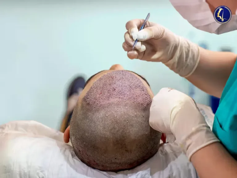 hair-transplant-in-islam-1